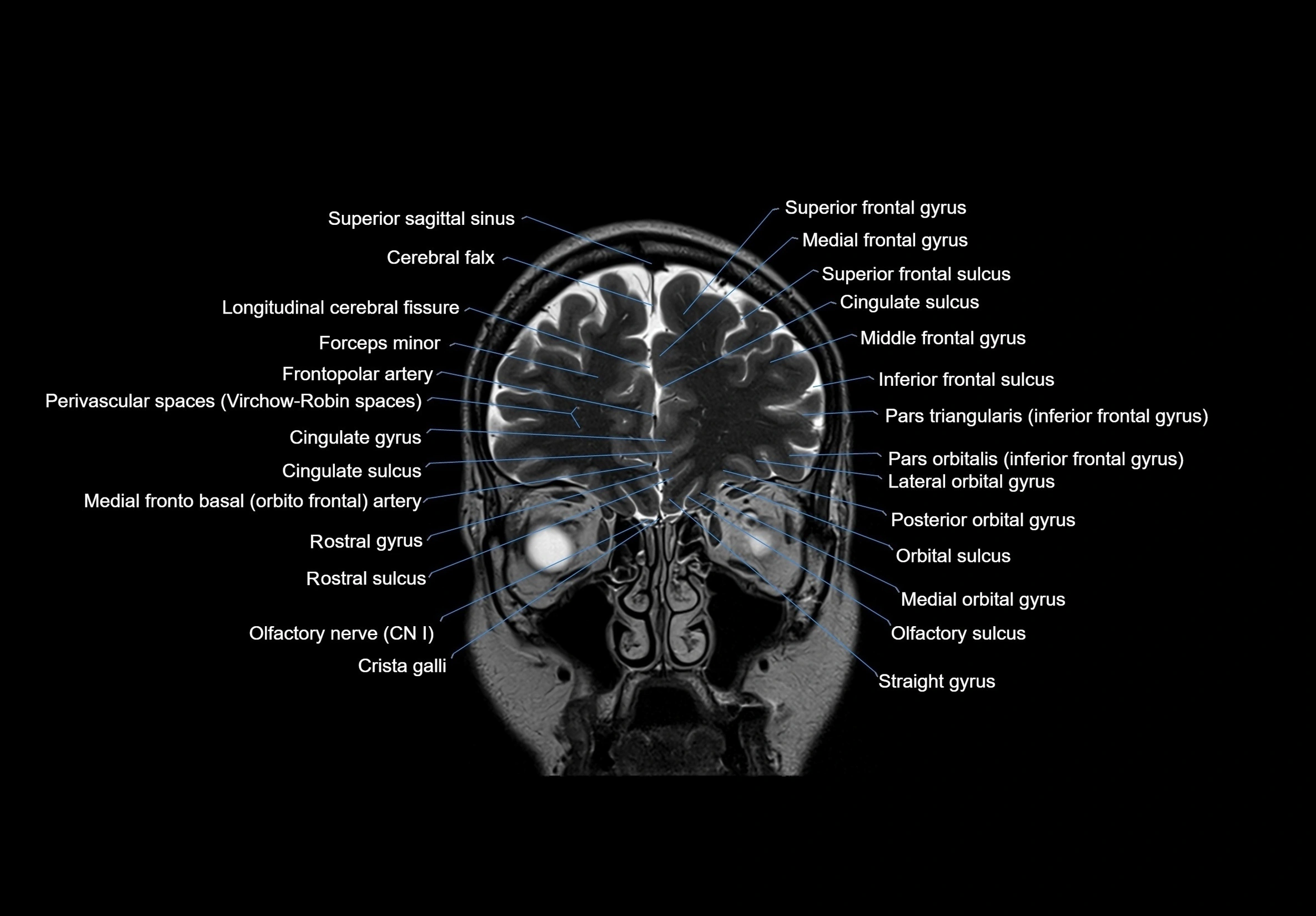 MRI Brain coronal cross sectional labelled anatomy 3T image  -img-00001-00016.webp